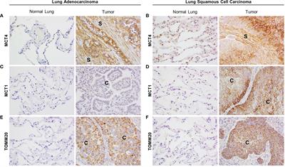 Monocarboxylate Transporter 4 in Cancer-Associated Fibroblasts Is a Driver of Aggressiveness in Aerodigestive Tract Cancers